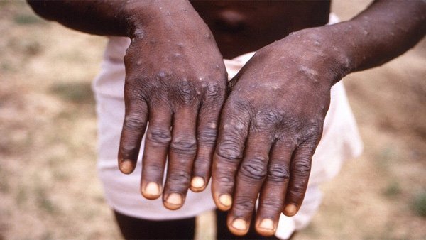monkeypox monkeypox